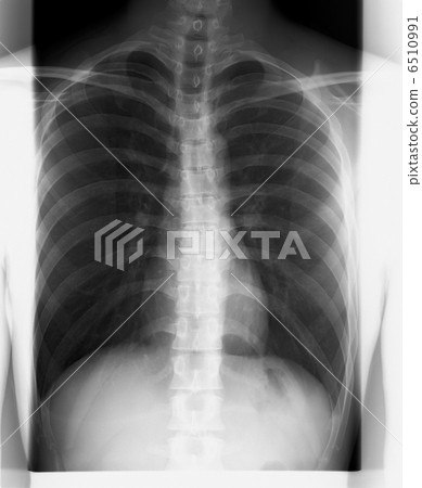 图库照片: x射线胸椎