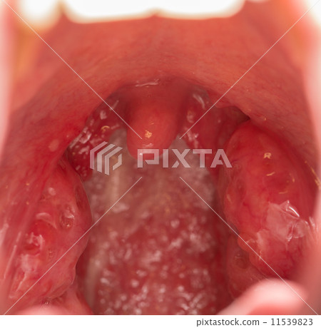 图库照片: open mouth view of tonsils