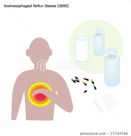 图库插图: gastroesophageal reflux disease or gerd