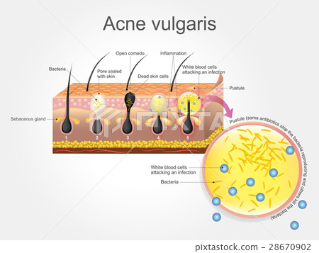 插图素材: acne vulgaris 查看全部