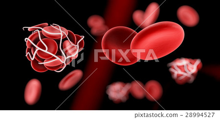 图库插图: blood clot and thrombosis medical 3d illustration