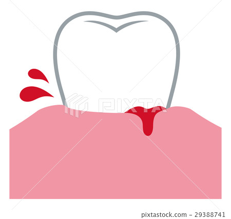 图库插图: 牙龈出血的牙周病