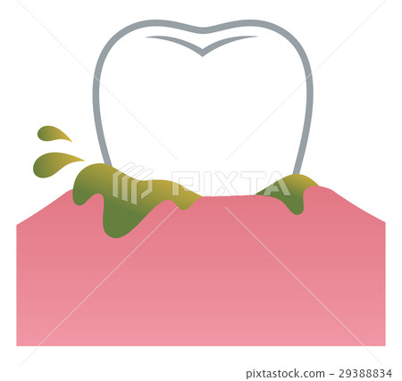插图素材 牙龈脓液牙周病
