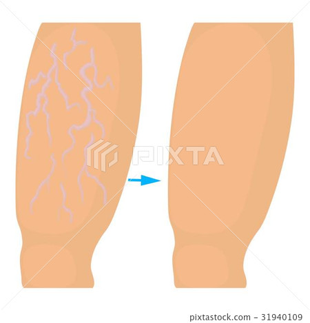 Varicose Veins Operation Icon Cartoon Style Stock Illustration