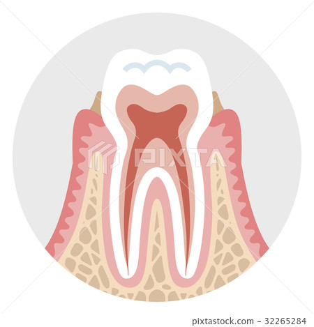 插图素材: 早期牙周炎牙齿的剖面图
