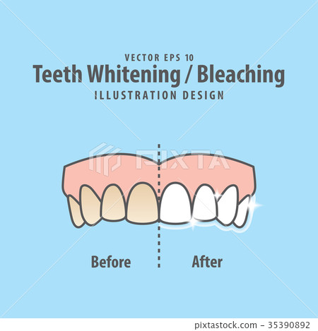 插图素材: compare upper teeth whitening-bleaching vector