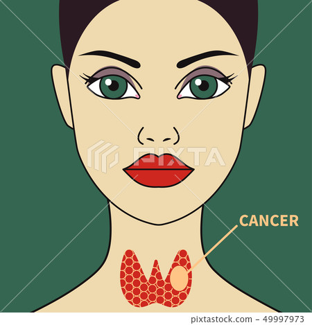 Thyroid Cancer In Woman Stock Illustration 49997973 PIXTA