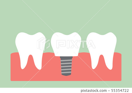 插图素材: dental implant with crown 查看全部