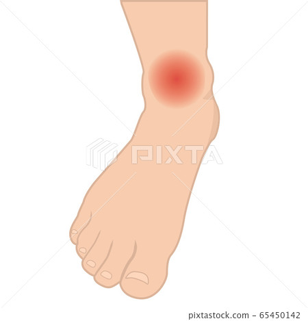 Swelling Of The Feet And Ankles From Infected Stock Illustration