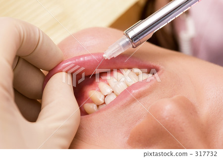 牙科治療圖像（麻醉注射） 317732