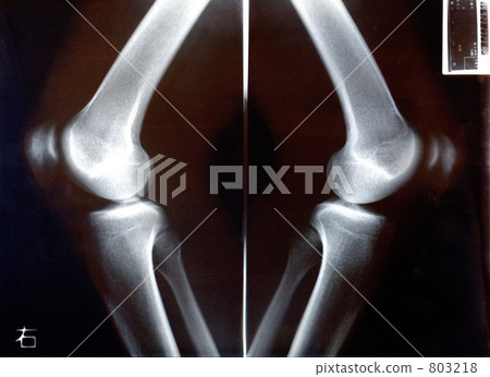 From the joint side of the knee taken with an X - ray 803218