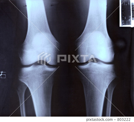 From the back of the joint of the knee taken with X - ray 803222