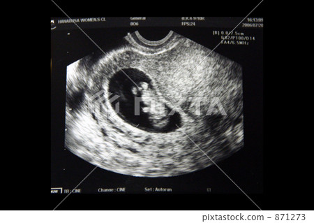 fetu, gravid, pregnancy 871273