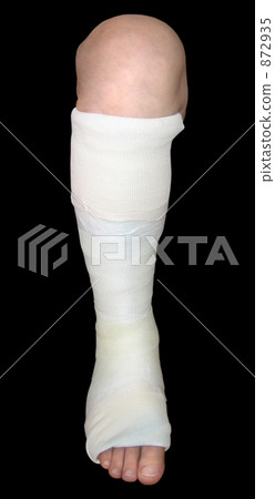 Fractured and wearing a cast leg Front Angle Black Background Fractured and wearing a cast leg Front Angle Black Background 872935