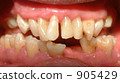 Periodontal disease Periodontal disease 905429