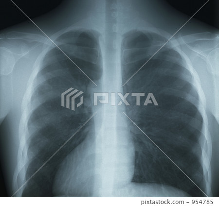 Chest X-ray Photo 954785