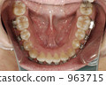 Orthodontic (lower jaw) Orthodontic (lower jaw) 963715