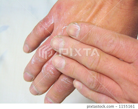 防止手粗糙度 - 4 防止手粗糙度 - 4 1155161