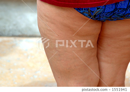 Cellulite of anxious thighs 1551941