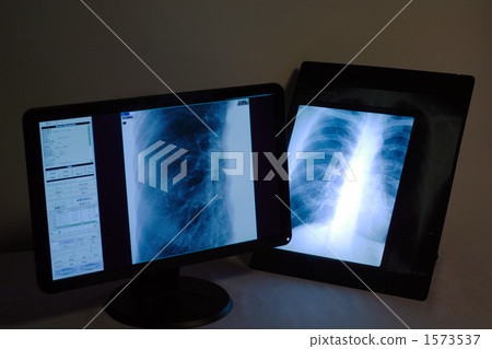 lung, pulmonary, x ray 1573537