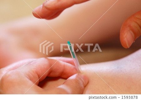 Acupuncture treatment 1593878