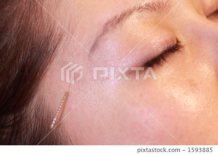 針灸治療 針灸治療 1593885