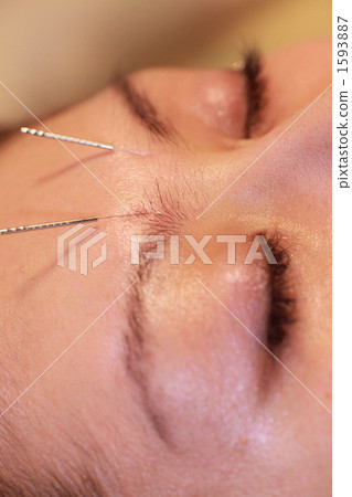 針灸治療 1593887