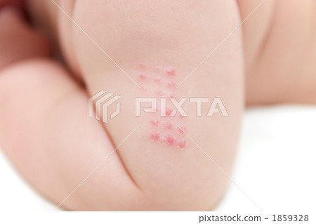 Immunisation, vaccination, vaccine 1859328