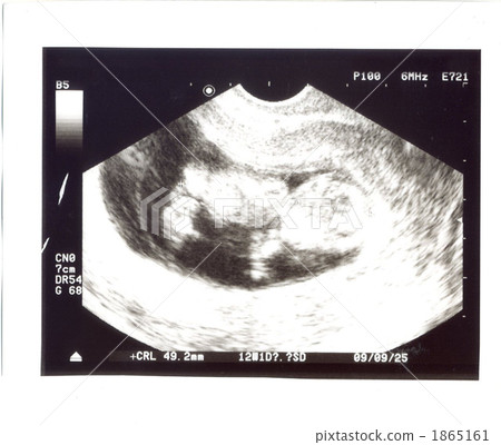 Echo picture 4 months Echo picture 4 months 1865161