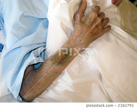 Subcutaneous bleeding in the elderly's arm Subcutaneous bleeding in the elderly's arm 2162791