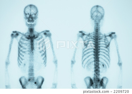 骨閃爍掃描術 2209720