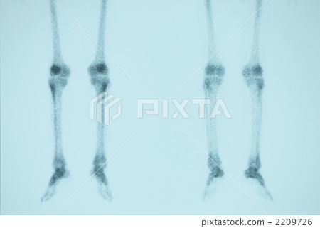 Bone scintigraphy Bone scintigraphy 2209726
