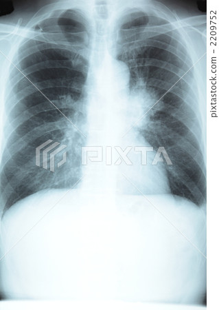 Chest X-ray Photo 2209752
