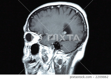 MRI tomogram of the brain 2209862