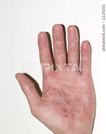 皮疹 皮膚不好 粗糙的皮膚 2229201