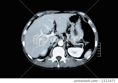 Abdominal CT 2312471