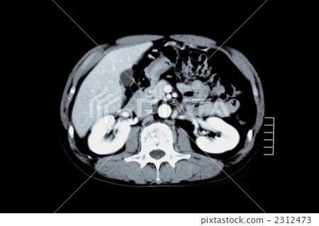 Abdominal CT Abdominal CT 2312473