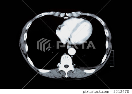 胸部CT 胸部CT 2312478