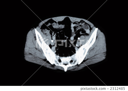 骨盆CT 2312485