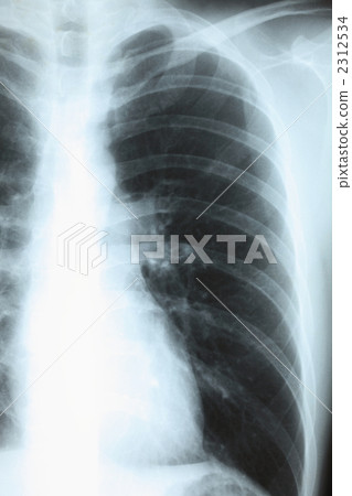 Chest X-ray Photo 2312534