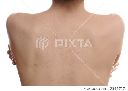 Back of a woman's acne trace Back of a woman's acne trace 2343717