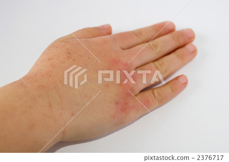 皮膚過敏，右手 2376717