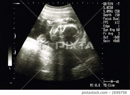 Echo photo (20 weeks) Echo photo (20 weeks) 2699786