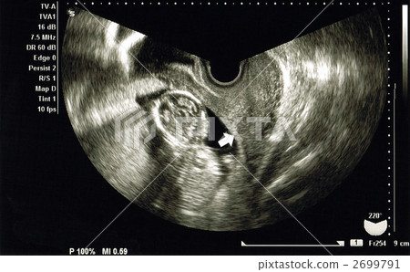 Echo photo (14 weeks) 2699791