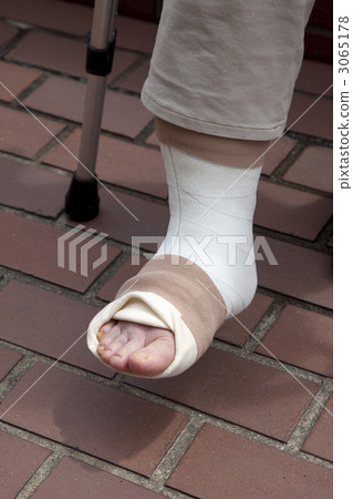 Fractured foot 3065178