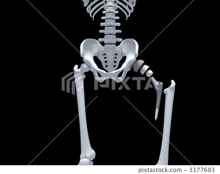 人工關節 人工關節 3177683