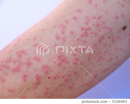 Caterpillar dermatitis - Stock Photo [3189463] - PIXTA