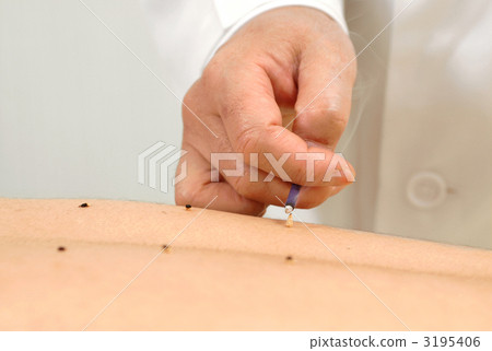 acupuncture and moxibustion, moxibustion, chinese medicine 3195406
