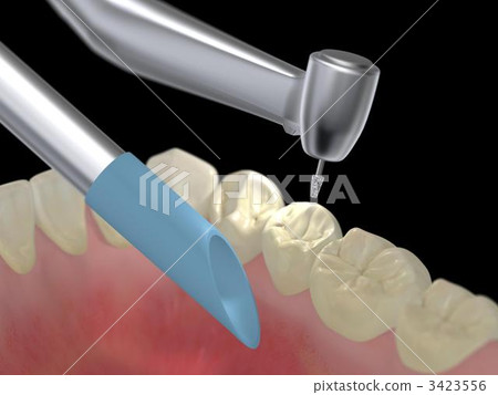 Dental treatment 3423556