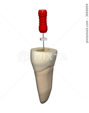 Root canal treatment 3668004